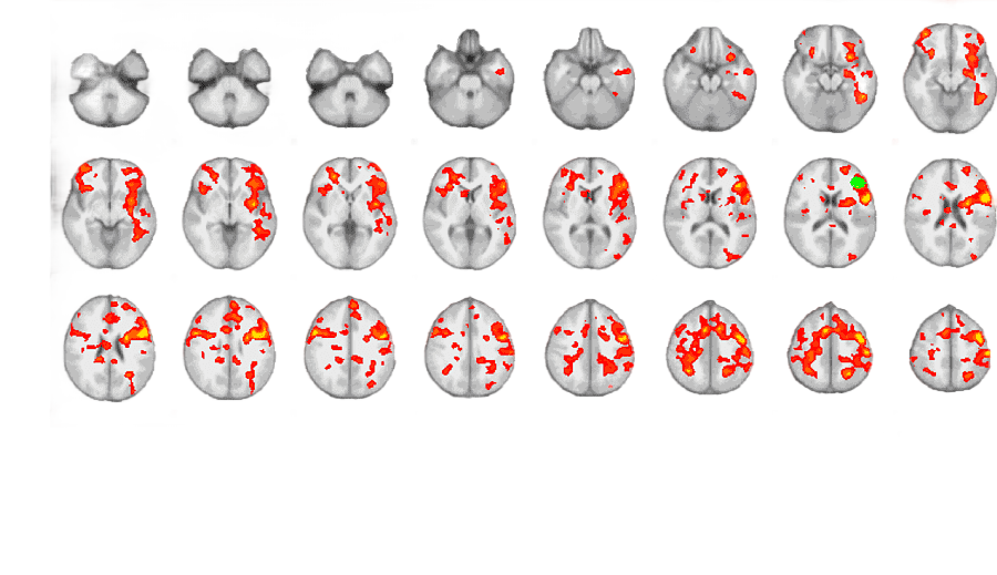 png clipart functional magnetic resonance imaging brain default mode network functional ne