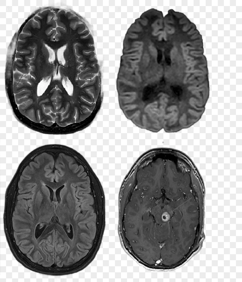 png clipart gadoteric acid neurofibromatosis type ii magnetic resonance imaging others mis