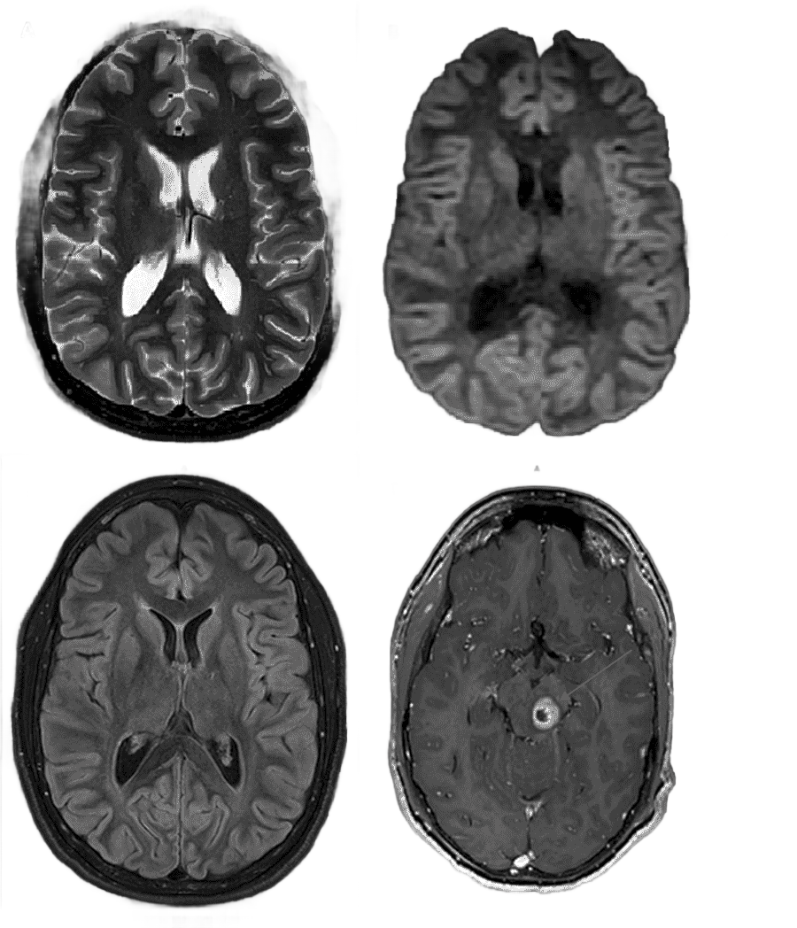 png clipart gadoteric acid neurofibromatosis type ii magnetic resonance imaging others mis