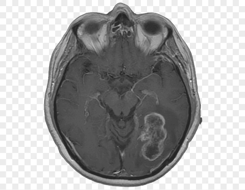 png clipart glioma glioblastoma magnetic resonance imaging debulking malignancy others mis