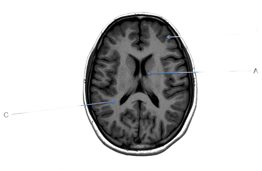 png clipart magnetic resonance imaging of the brain computed tomography magnetic resonance